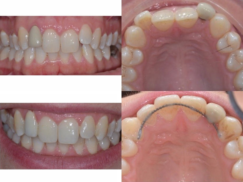Adult Braces Quick Straight teeth Dentist Huddersfield